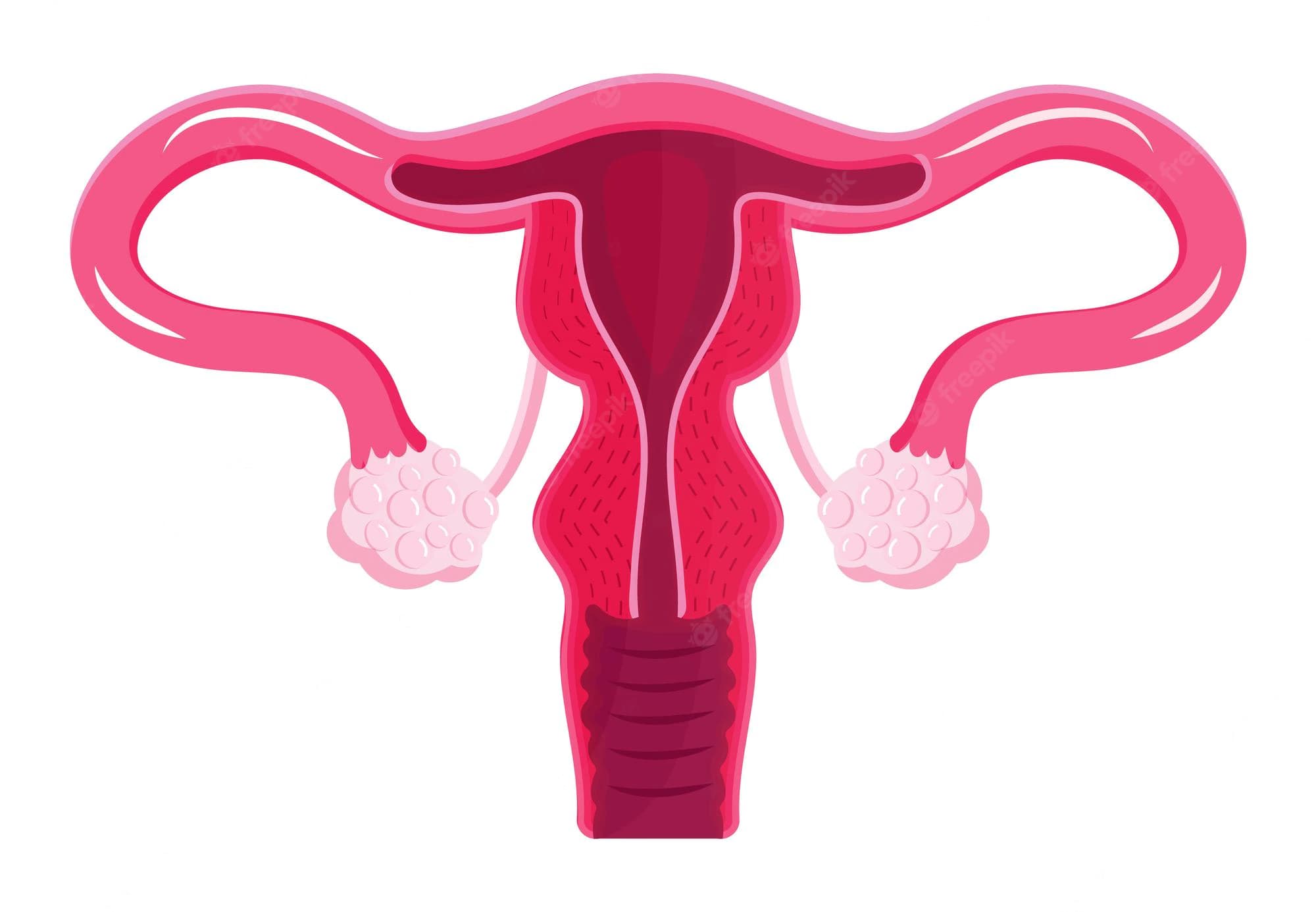 Endometriozis (Çikolata Kisti) Nedir? Çikolata Kisti Belirtileri Nelerdir?