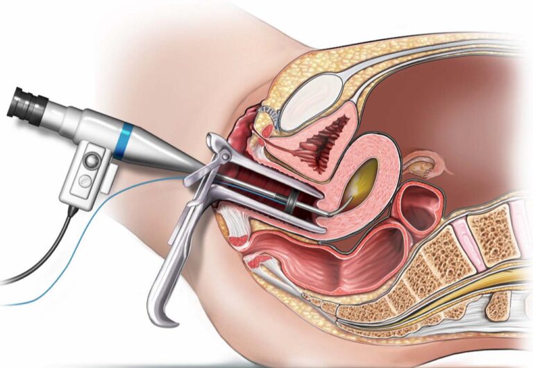 Tüp Bebek Tedavisinde Histeroskopi