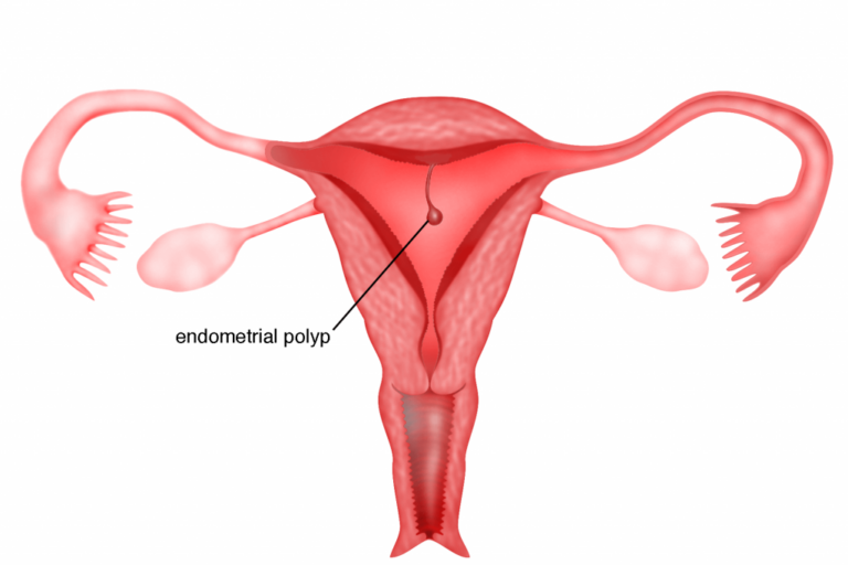 Polip Nedir? Endometrial Polip (Rahimde Polip) Nedir?